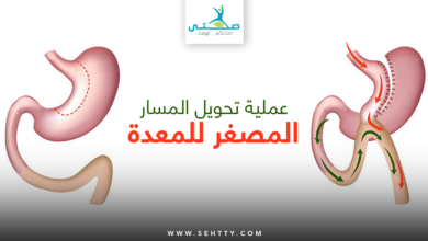 تحويل المسار المصغر للمعدة