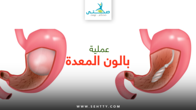 عملية بالون المعدة