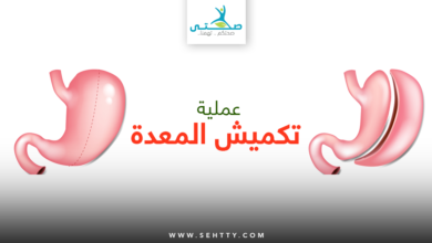 عملية تكميش المعدة