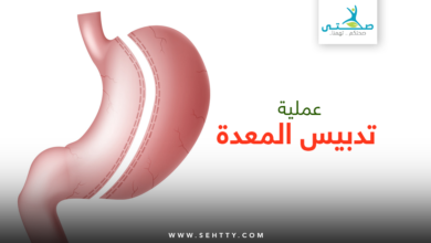 عملية تدبيس المعدة