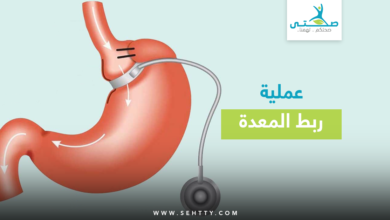 عملية ربط المعدة